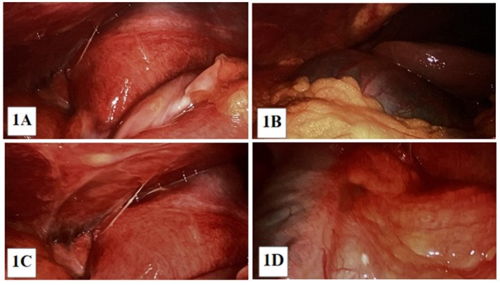 Laparoscopic images reveal widespread erythema on the peritoneal surface.